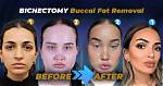 A Deeper Dive into Buccal Fat Removal