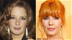 Beth Dutton Lip Injections: Surgery Before and After Photos