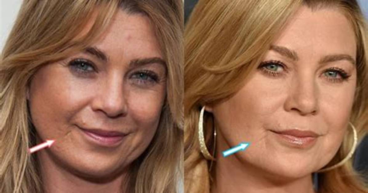 Ellen Pompeo's Lip Filler Journey: a Closer Look