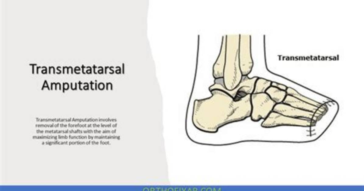 Essential Guide to Transmetatarsal Amputation: Recovery and Rehabilitation