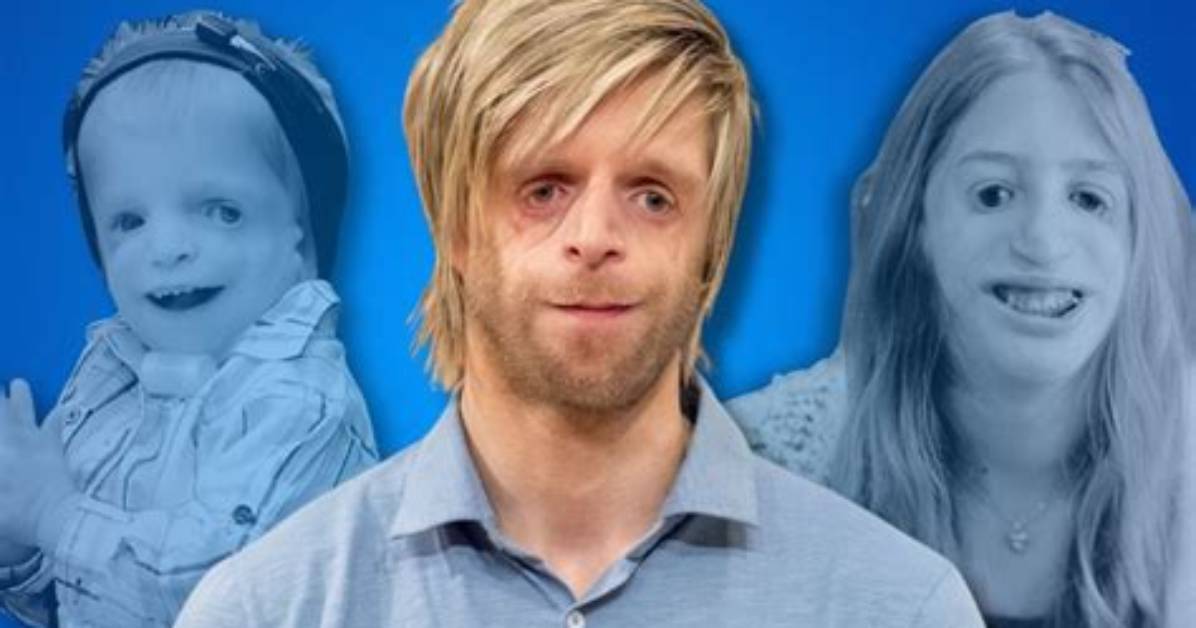Famous Personalities Living with Treacher Collins Syndrome