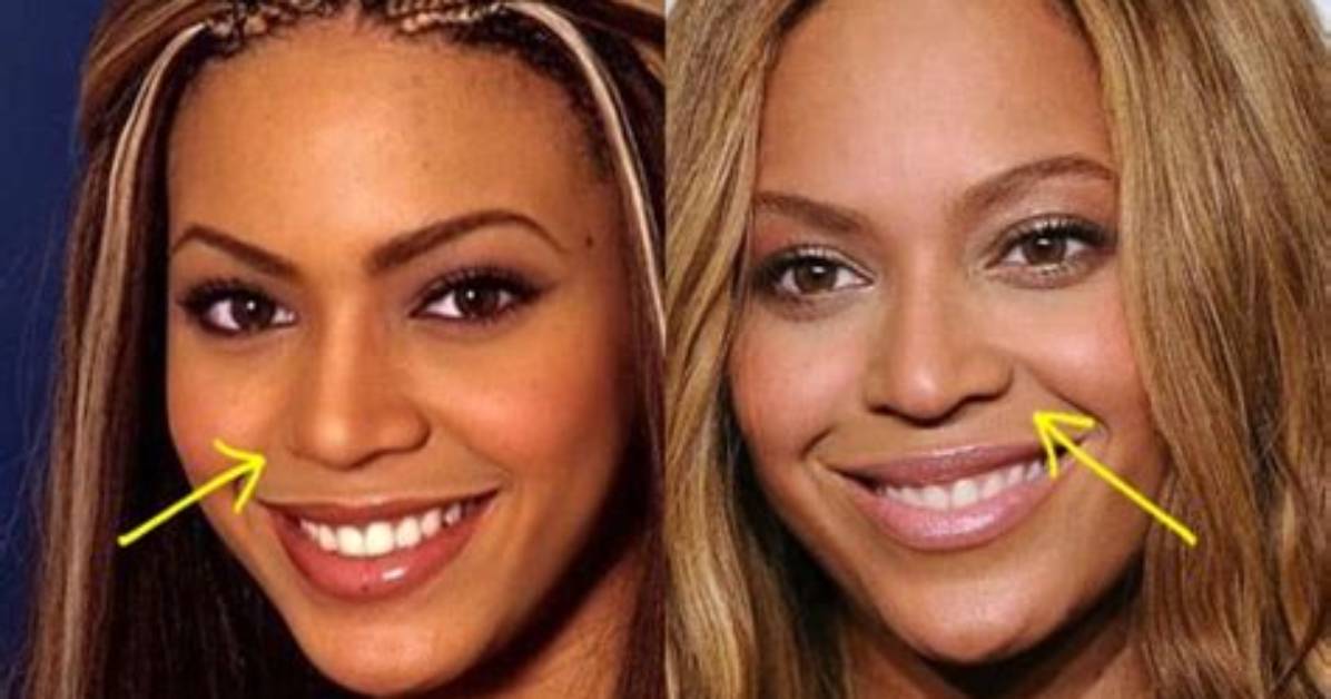 Has Beyonce Had a Nose Job or Plastic Surgery?