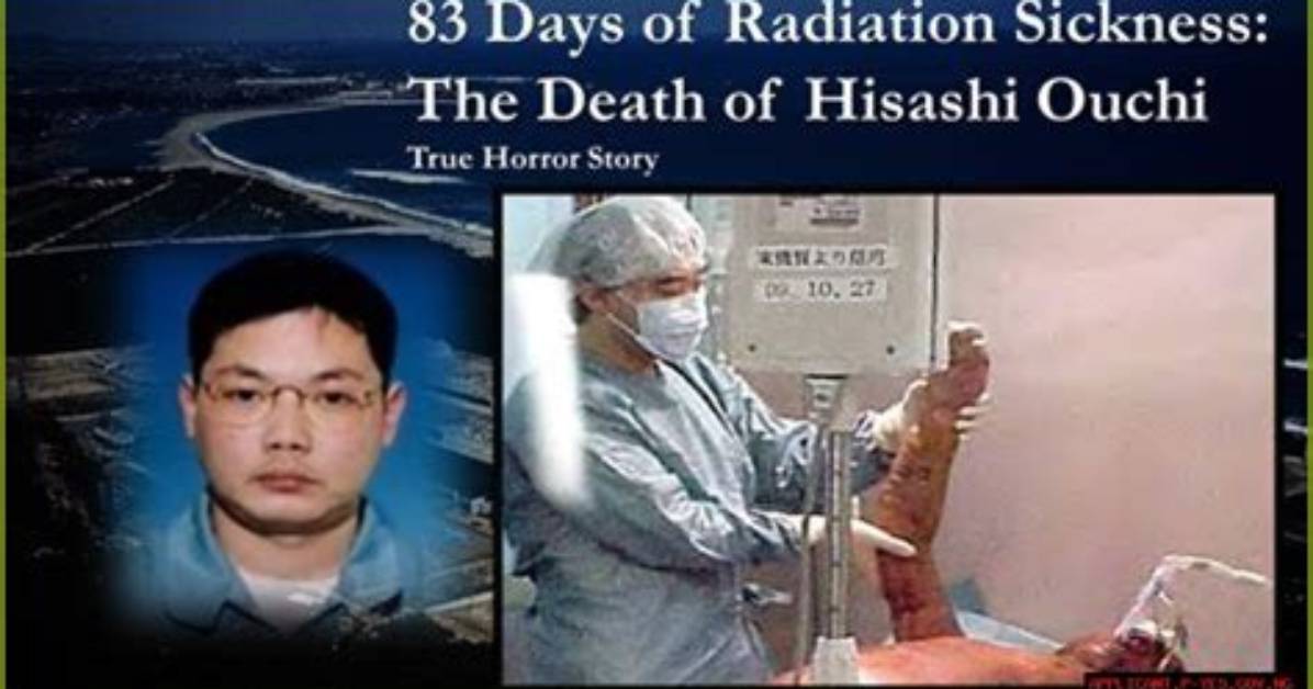 Hisashi Ouchi: a Tragic Tale of Nuclear Accident and Endurance