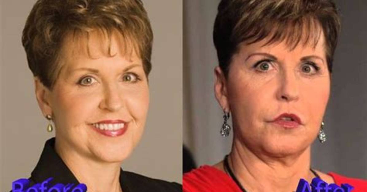 Joyce Meyer's Facelift: Uncovering the Truth