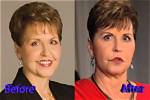 Joyce Meyer's Transformation Before and After Plastic Surgery