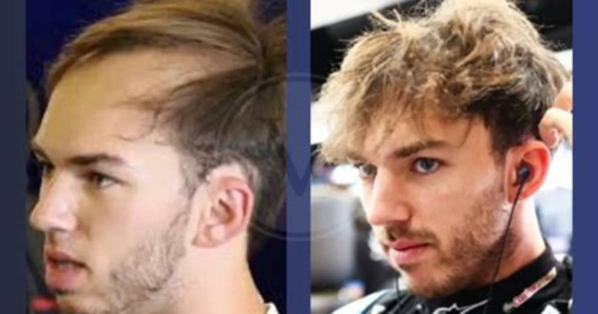 Pierre Gasly: the Evolution of His Hair and Style