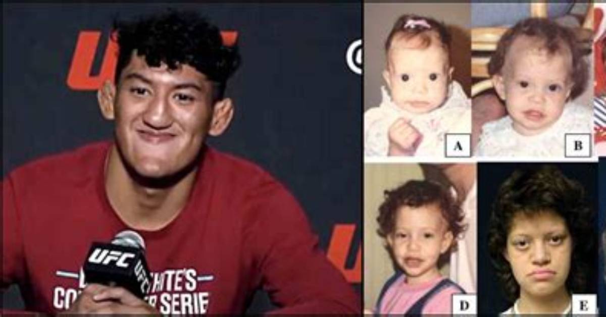 Raul Rosas Jr.'s Unusual Facial Condition: a Medical Mystery