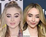 Sabrina Carpenter's Botox Transformation: Before and After