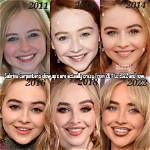 Sabrina Carpenter's Lip Filler Journey: a Candid Look at the Procedure