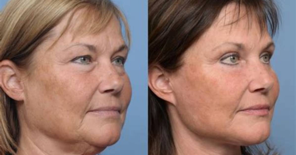 Susan Page's Facelift: Before and After Photos