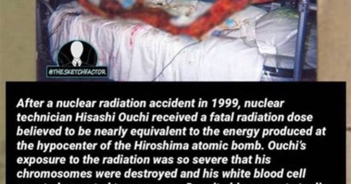 **The Incredible Journey of Hisashi Ouchi After Radiation Exposure**