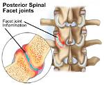 Understand Hypertrophic Facet Arthropathy: a Comprehensive Medical Definition
