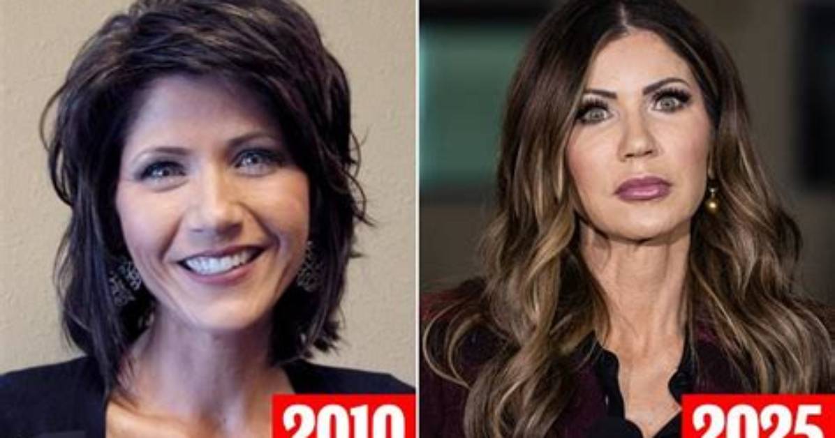 Unrecognizable! the Complete Transformation of Kristi Noem's Face