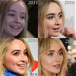 Unveiling the Transformation: Sabrina Carpenter Before Lip Filler