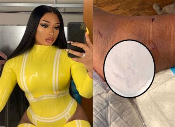 When Was Megan Thee Stallion Shot? Foot Injury Pictures Surface from Tory Lanez Trial